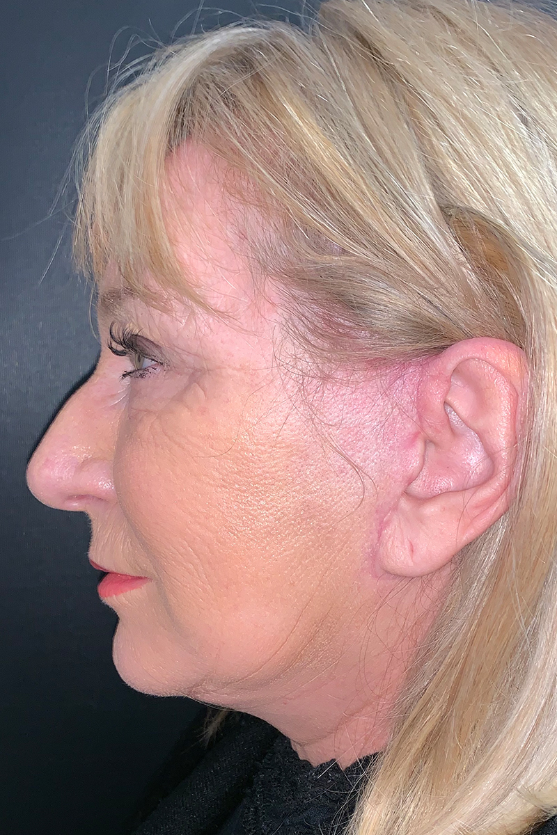 View 2 — before (pre-operative)